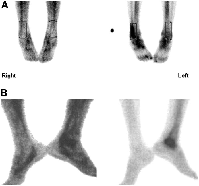 Ceretec white blood cell scan