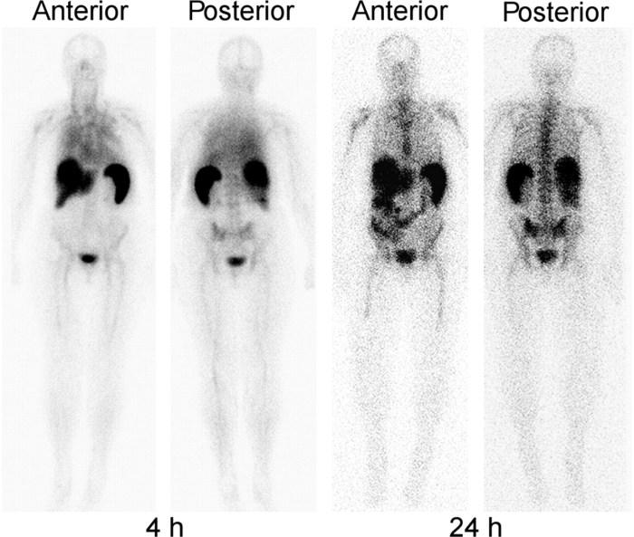 Ceretec white blood cell scan